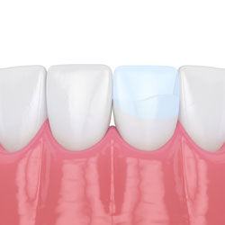 Tooth Colored Fillings in Kenosha, WI