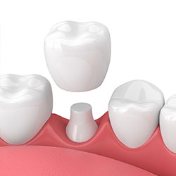 Tooth Colored Fillings in Kenosha, WI